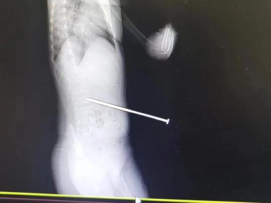 虫子钻脚趾、12cm钉子扎腰里?露营风正劲,这些隐患很致命!现场实探 虫子钻脚趾、12cm钉子扎腰里?露营风正劲,这些隐患很致命!现场实探