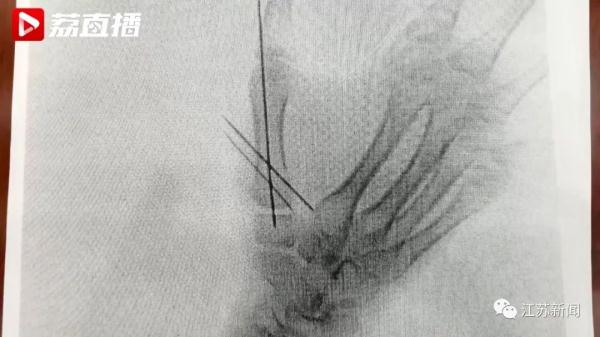 15岁女生玩密室逃脱致手掌骨骨折!家人把商家告上了法庭 15岁女生玩密室逃脱致手掌骨骨折!家人把商家告上了法庭