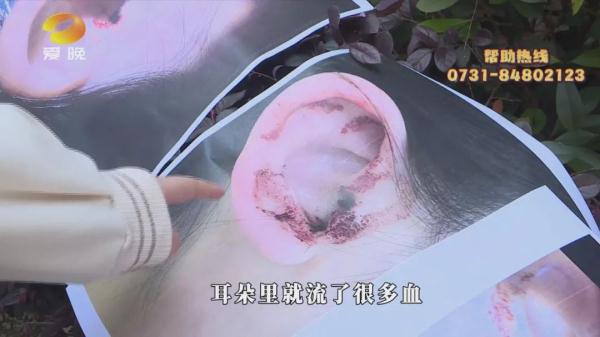 索赔一万元！女子感染真菌性外耳道炎，竟是因为...