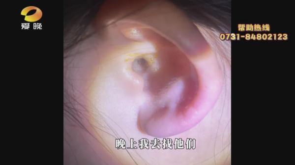 索赔一万元！女子感染真菌性外耳道炎，竟是因为...