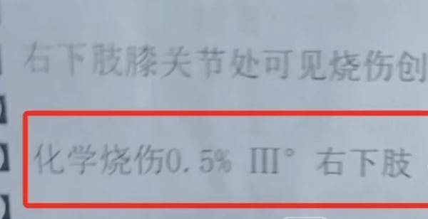 不慎溅出，一秒烧破裤子烧到肉成三级伤！你家有这种东西吗？