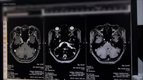 “眼皮跳”没重视,结果半边脸都…… “眼皮跳”没重视,结果半边脸都……