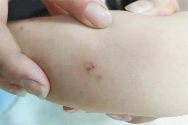 近期高发！6岁男孩被咬 假期出游尤其要注意！