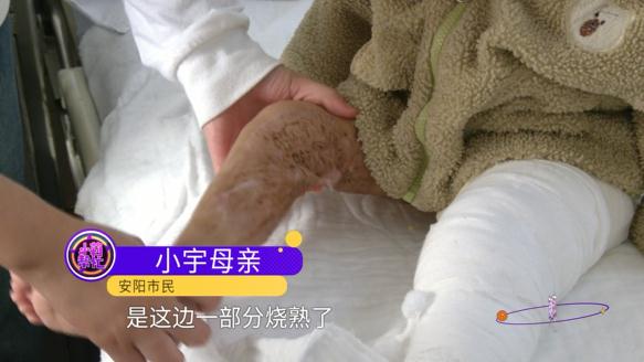 心疼！10个月大婴儿被开水烫伤，所幸…