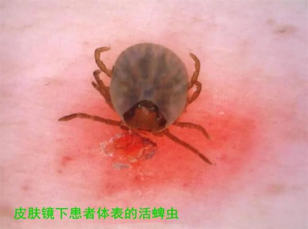 警惕！西安已有多名儿童遭此物攻击！丨西安一区发布提醒
