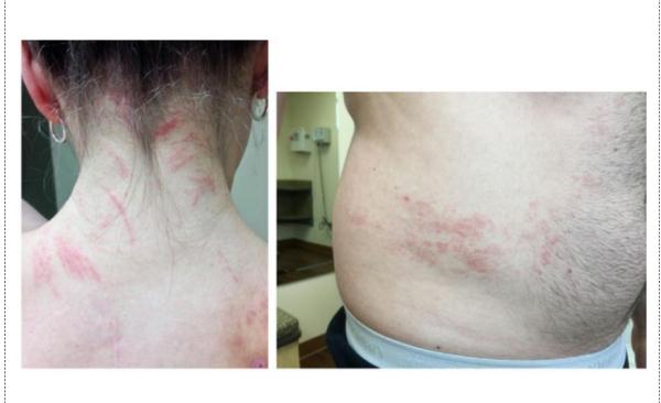 一顿烧烤后，女子全身似遭“鞭打”，竟是因为这种常见的食物？