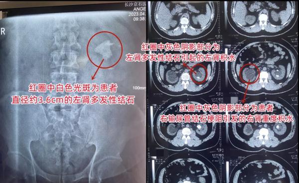 男子多次尿血却从未在意，偶然就医检查才知肾脏藏“大家伙”