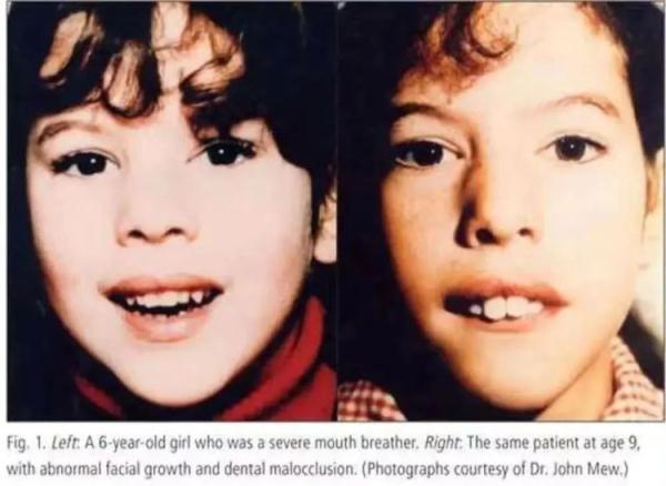 感觉孩子越长越丑?一查竟是它在作怪…… 感觉孩子越长越丑?一查竟是它在作怪……