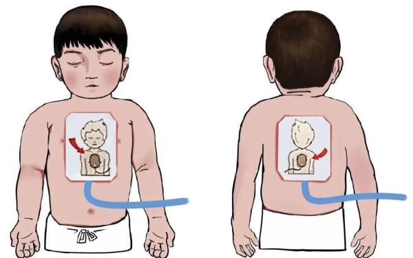 关键时刻能“救命”!常用急救知识合集 关键时刻能“救命”!常用急救知识合集