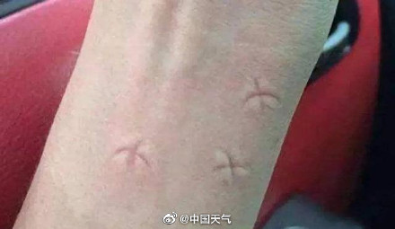 被蚊子咬是夏天专属的痛