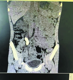 8岁娃腰腹疼痛 一查竟是肾结石