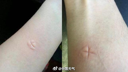 被蚊子咬是夏天专属的痛