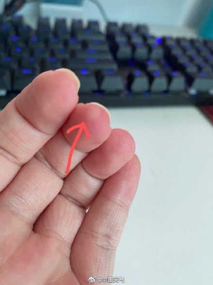 被蚊子咬是夏天专属的痛