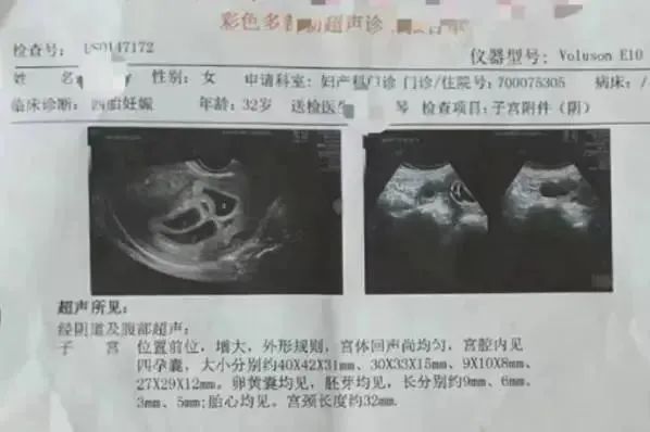 刚生完四胞胎又怀上四胞胎 刚生完四胞胎又怀上四胞胎