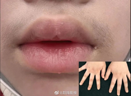 孩子身上长小疙瘩可能是感染HPV