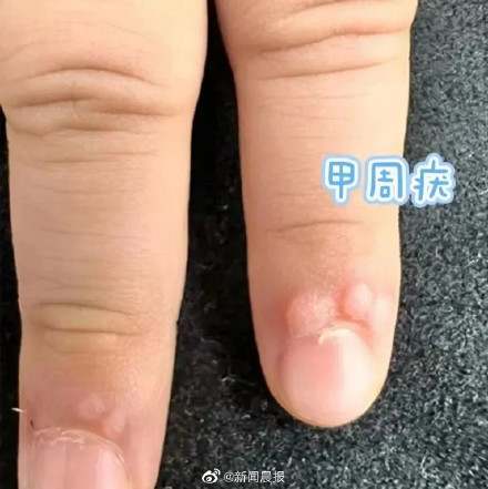 孩子身上长小疙瘩可能是感染HPV