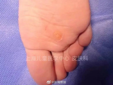 孩子身上长小疙瘩可能是感染HPV