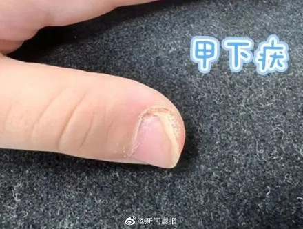 孩子身上长小疙瘩可能是感染HPV