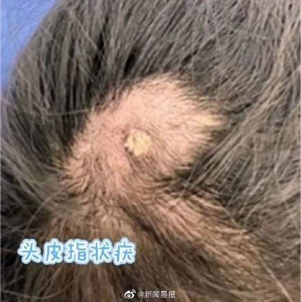 孩子身上长小疙瘩可能是感染HPV