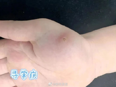 孩子身上长小疙瘩可能是感染HPV