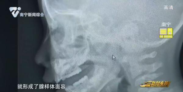 “腺样体面容”登热搜!孩子打鼾家长应注意 “腺样体面容”登热搜!孩子打鼾家长应注意