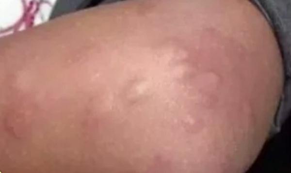 警惕！被这种小虫咬后奇痒无比，广东户外很常见
