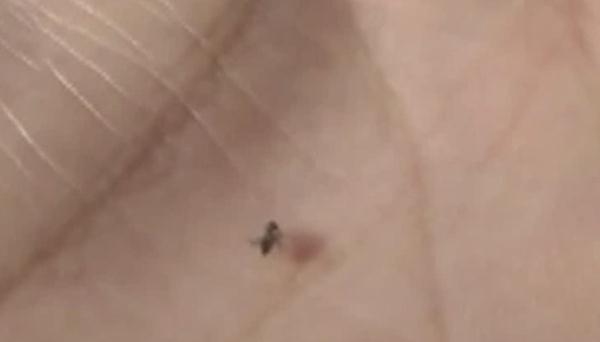 警惕！被这种小虫咬后奇痒无比，广东户外很常见