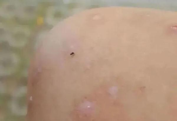 五月外出，当心这种长得像蚊子的小虫！此地有人中招