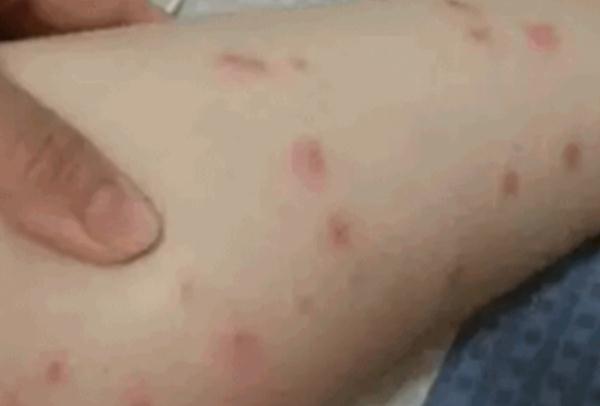 五月外出，当心这种长得像蚊子的小虫！此地有人中招
