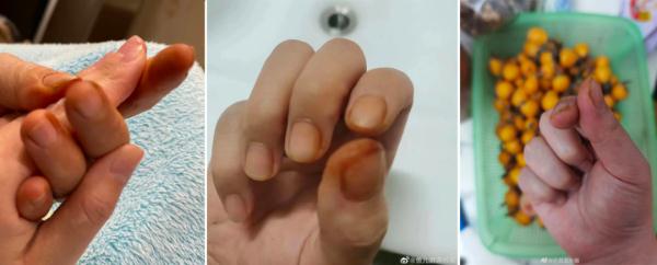 全网热议!多地网友称指甲变黄:根本停不下来! 全网热议!多地网友称指甲变黄:根本停不下来!