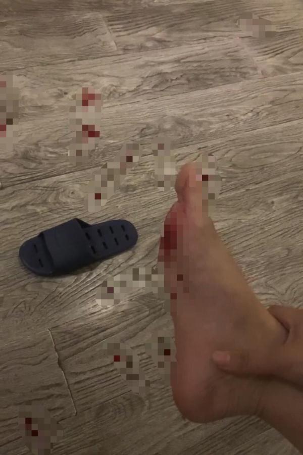 酒店拖鞋上有刀片！女子被扎伤担心感染艾滋，酒店：她要1万赔偿