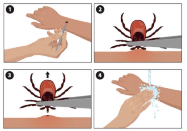 5岁男孩突然发烧全身红斑,是它惹的祸!户外活动千万当心 5岁男孩突然发烧全身红斑,是它惹的祸!户外活动千万当心