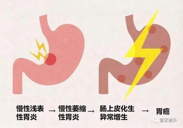 如何看懂胃镜检查单——胃息肉