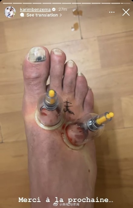 本泽马体验中医拔罐 本泽马体验中医拔罐