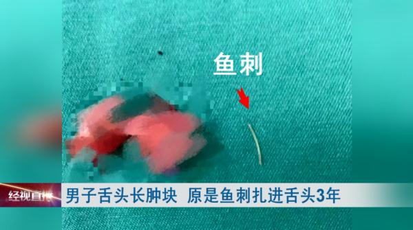 男子舌头长肿块，一检查才发现…医生提醒：小心癌变！