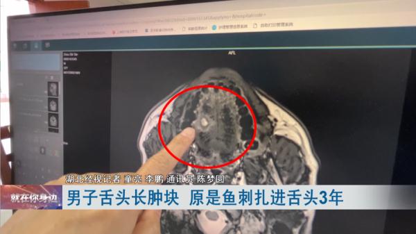 男子舌头长肿块，一检查才发现…医生提醒：小心癌变！