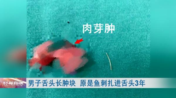 男子舌头长肿块，一检查才发现…医生提醒：小心癌变！