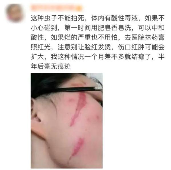 “我的脸被它毁容了”！重要提醒：这种虫千万别拍，毒液堪比硫酸
