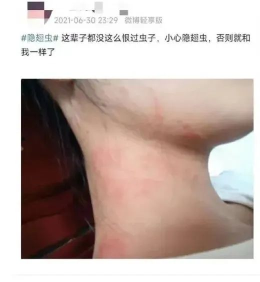 “我的脸被它毁容了！”遇到这种虫子，千万别用手拍