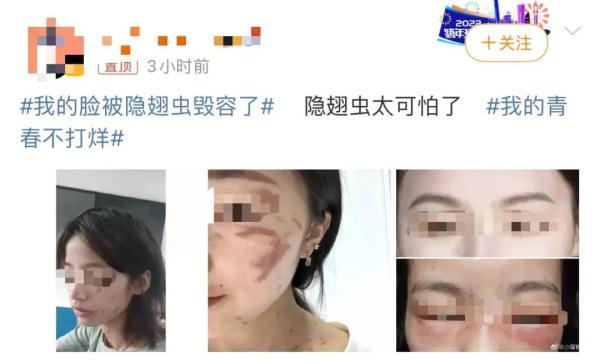 “我的脸被隐翅虫毁容了”，引183万人热议