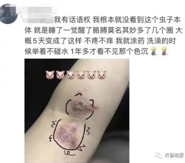 “我的脸被隐翅虫毁容了”，引183万人热议