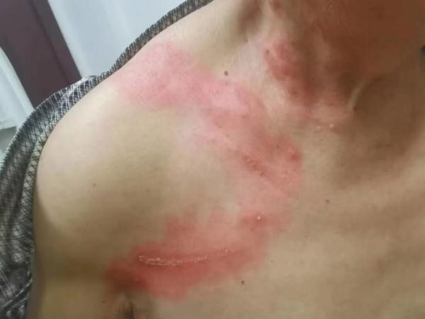 一觉醒来,杭州大伯胸口着火般的辣!医生提醒… 一觉醒来,杭州大伯胸口着火般的辣!医生提醒…