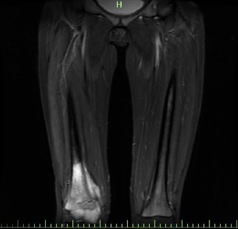 13岁女孩查出癌症！妈妈：一开始以为只是生长痛