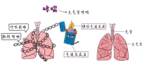 关于“哮喘”你一定要知道