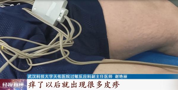 武汉男子吃热干面后全身瘙痒,医生紧急提醒! 武汉男子吃热干面后全身瘙痒,医生紧急提醒!