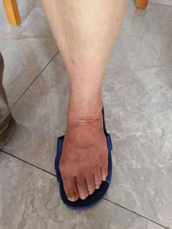 七旬老人一觉醒来左腿又凉又痛以为撞了邪医生如不及时处理将截肢