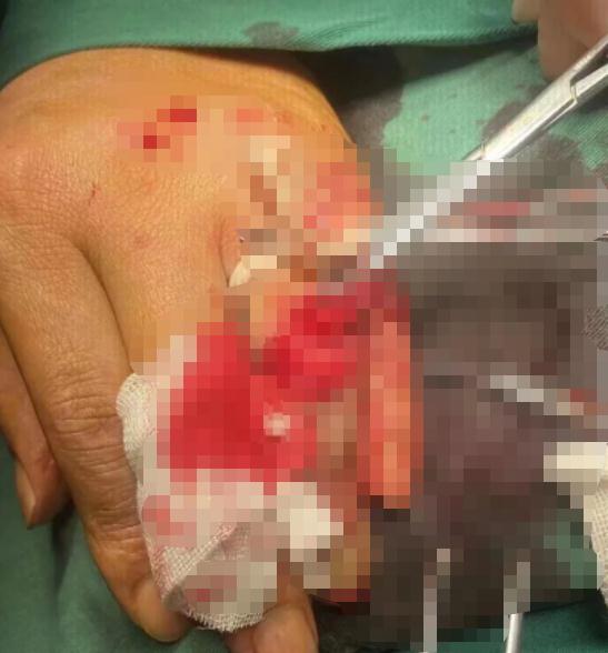 抓捕毒贩时，民警的手指几乎骨肉分离，血染警服！