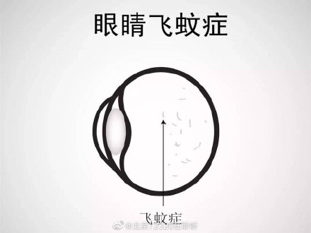 你知道什么是“飞蚊症”吗？