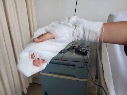 考前30天右手肌腱断裂，右撇子女生双手交替写字完成高考