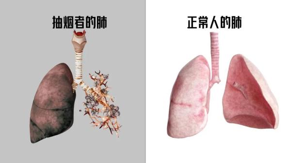 【岭南大医生】男子抽烟30年，脚趾头发黑要截肢？！